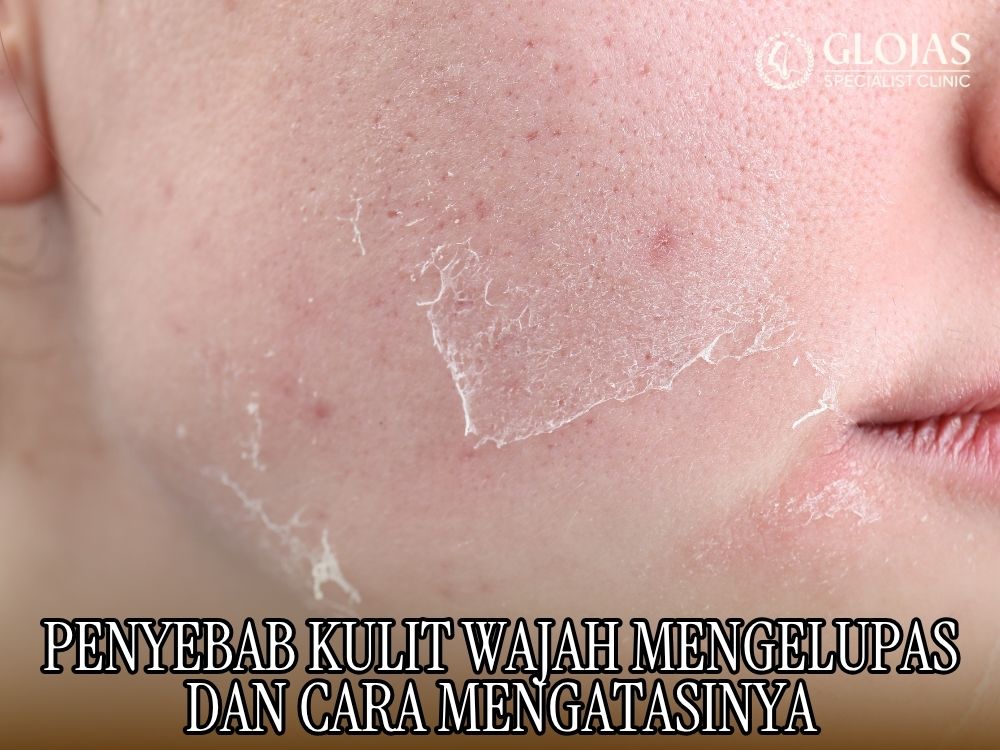 Penyebab Kulit Wajah Mengelupas dan Cara Mengatasinya