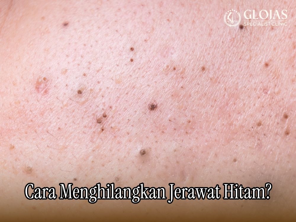 bekas jerawat hitam