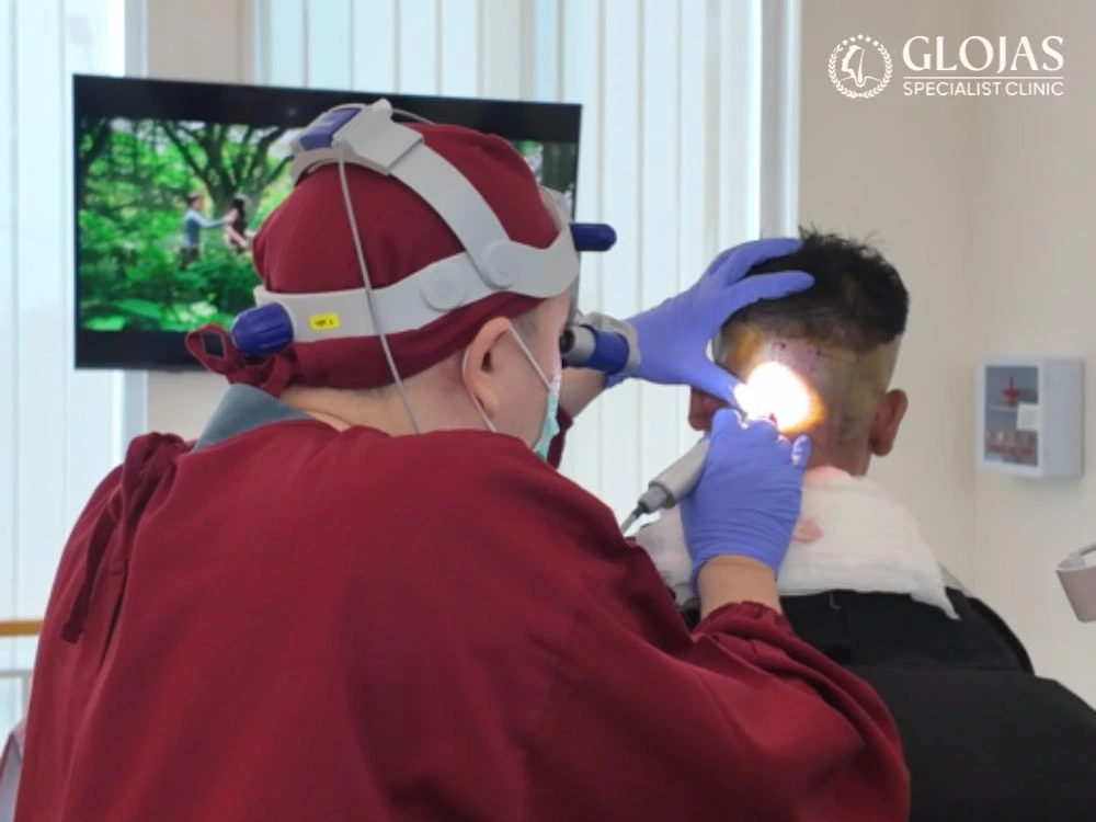 proses transplantasi: pengambilan folikel rambut