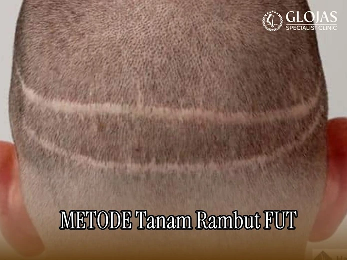 tanam rambut FUT