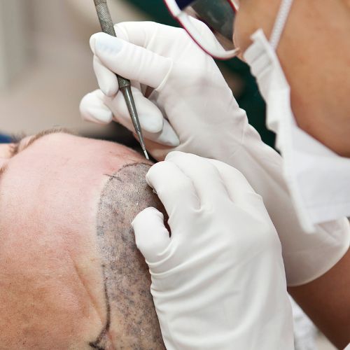 Tanam Rambut FUE di Klinik Rambut Glojas