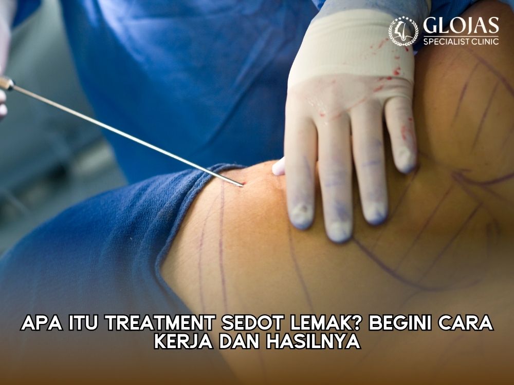 apa itu sedot lemak